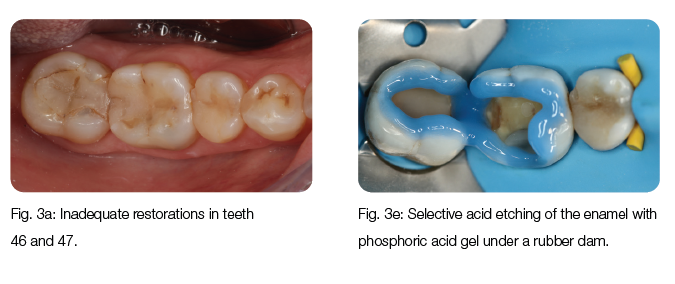 Process of restoration with lithium disilicate inlays